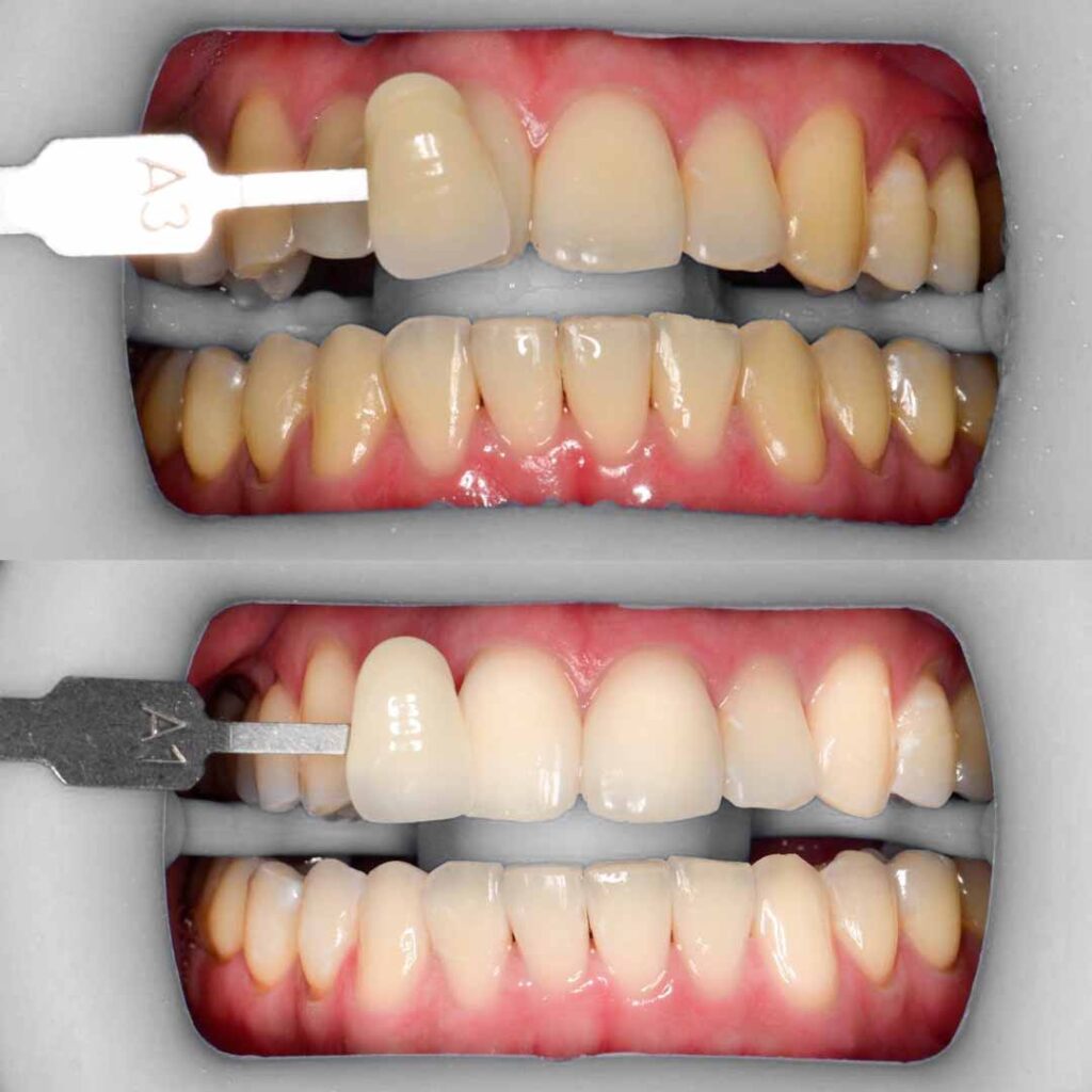 whitening_2