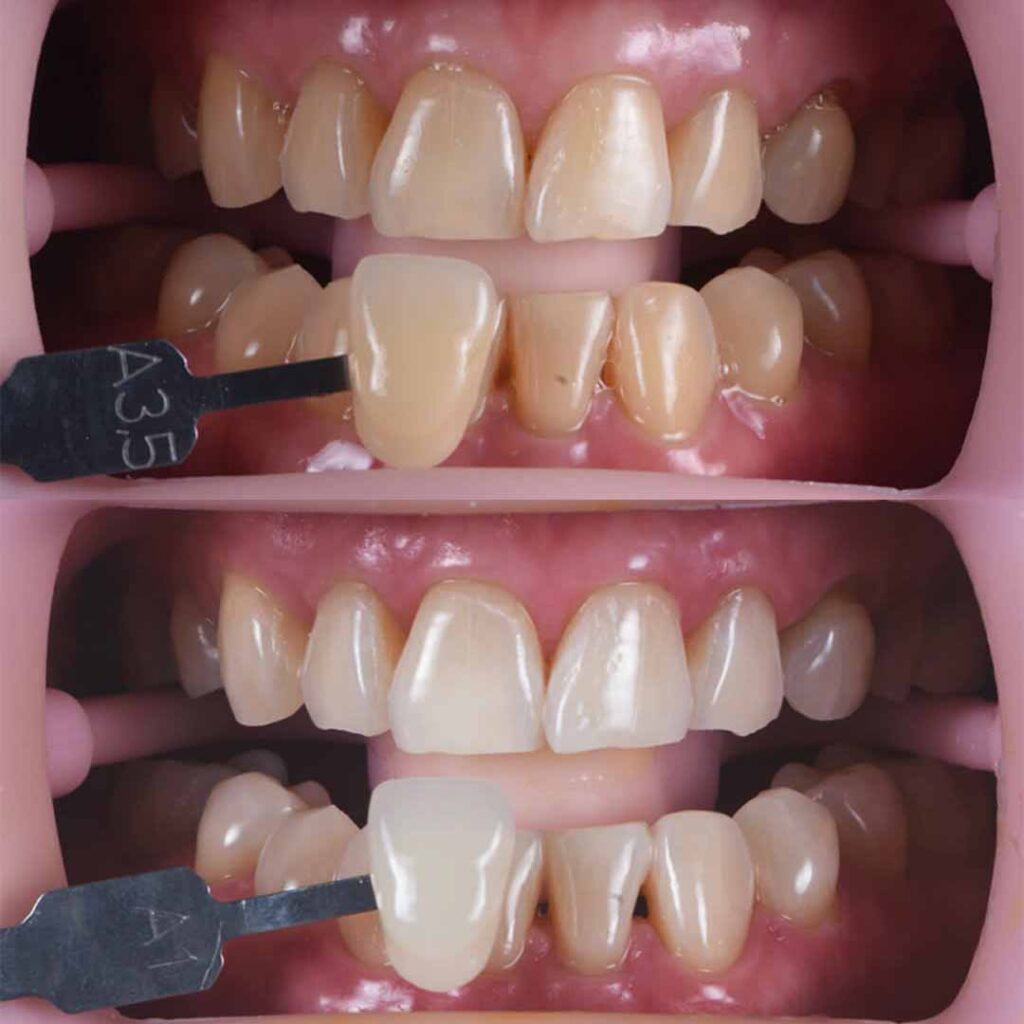 whitening_3